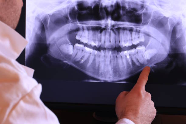 Best Emergency Tooth Extraction in Lexington, IL