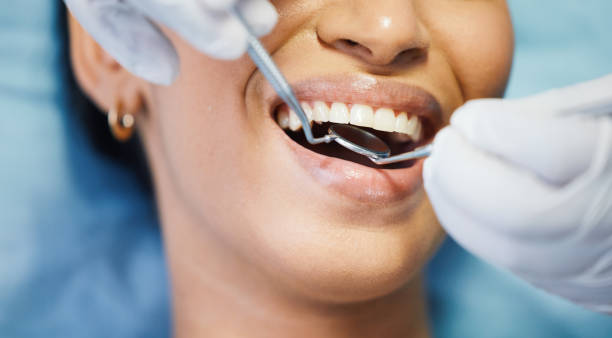 Best Emergency Wisdom Teeth Removal in Lexington, IL