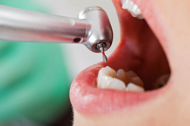 Best Emergency Treatment for Dental Infections or Abscesses in Lexington, IL